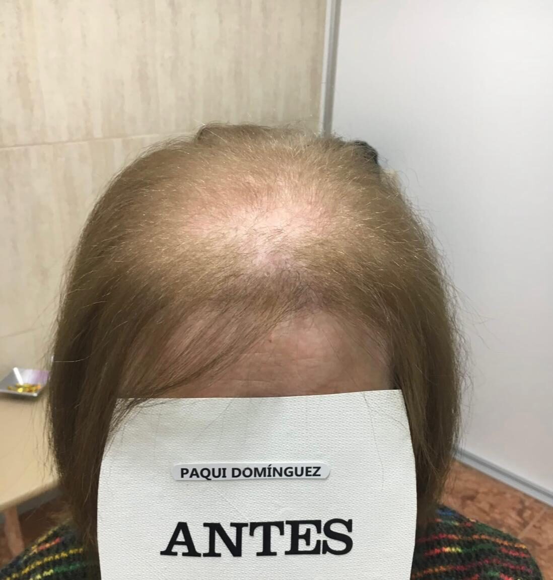 Coronilla con pérdida de densidad antes de colocar el sistema capilar