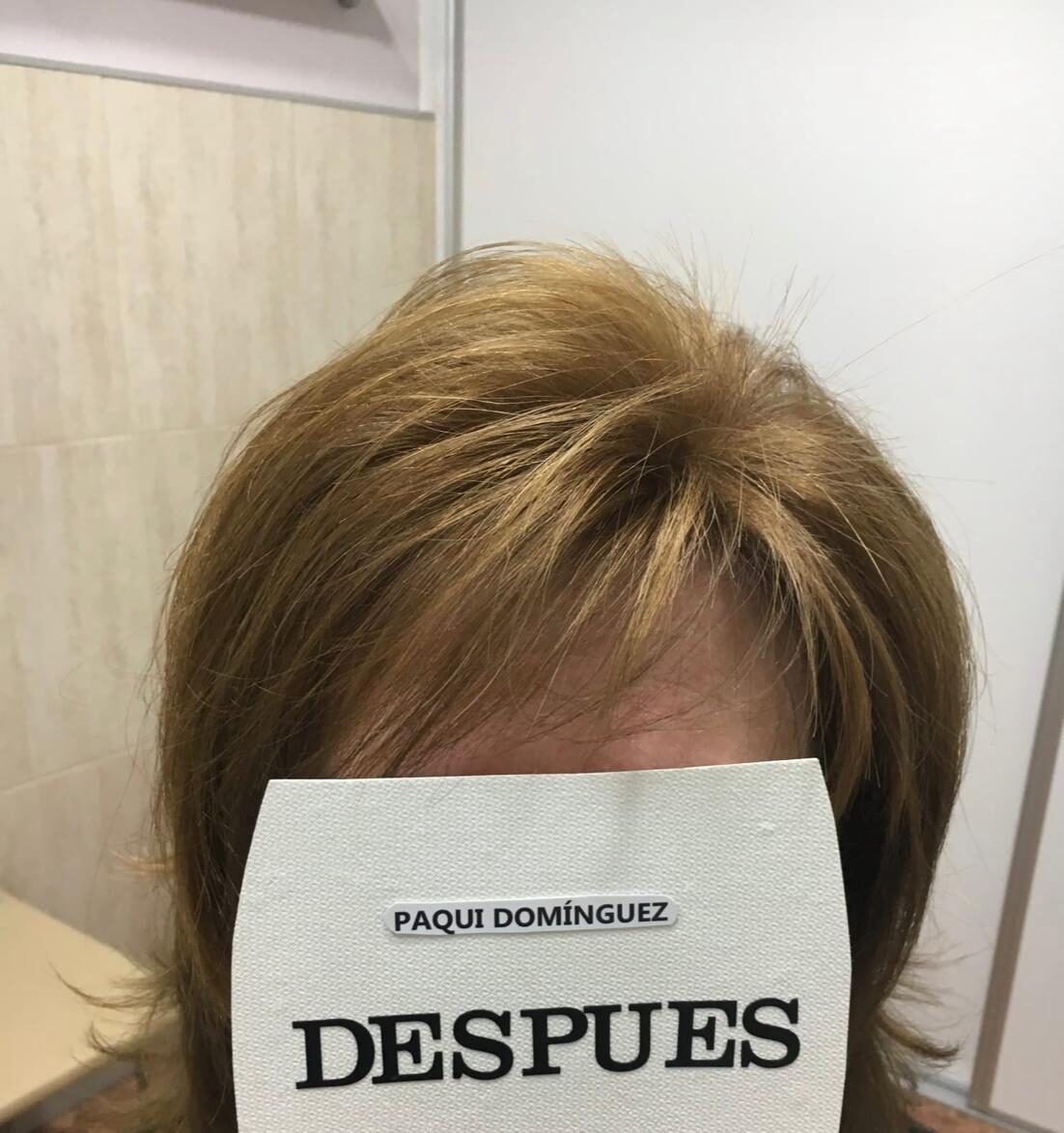 Misma coronilla con densidad y volumen tras colocar el sistema capilar